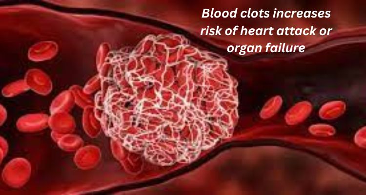 ब्लड क्लॉट होने से ऑर्गन फेलियर और हार्ट अटैक का खतरा, 