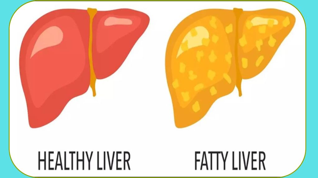 ये योगासन करने से नहीं होगी फैटी लिवर की समस्या, 