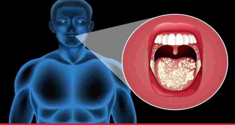 Mouth Cancer Causes : रोजमर्रा की इन पांच आदतों से 