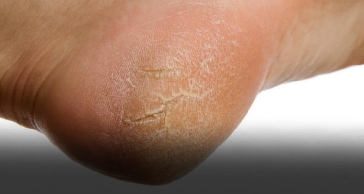 Know About Cracked Heels : सर्दियों में नमी होने से शुष्क हो जाती