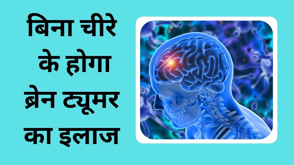 ZAP-X Radiosurgery से 30 मिनट में होगा ब्रेन ट्यूमर का इलाज, 