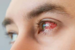 पंजाब में  बढ़ा Eye flu का खतरा