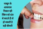 क्या आप नाखून के आसपास निकल रही स्किन को दांत से काटते हैं 
